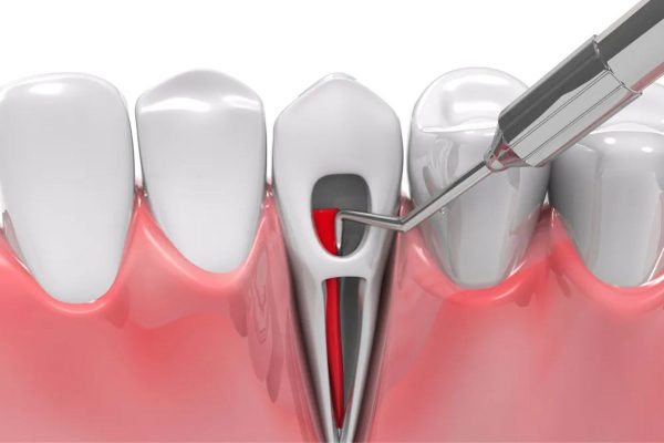 Điều trị tủy răng bị viêm không gây đau nhờ công nghệ hiện đại
