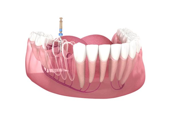 Điều trị tủy răng giúp ngăn ngừa biến chứng viêm tủy răng gây ra