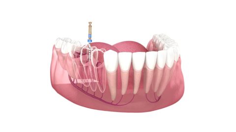 Điều trị tủy răng như thế nào đúng cách?