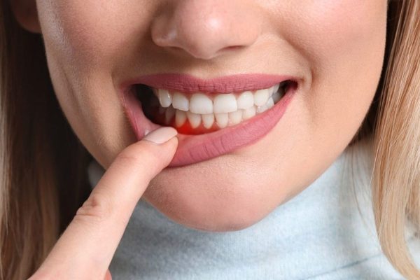 Viêm lợi là kết quả của quá trình vi khuẩn có hại tấn công, phá hủy các tổ chức mô nướu quanh răng