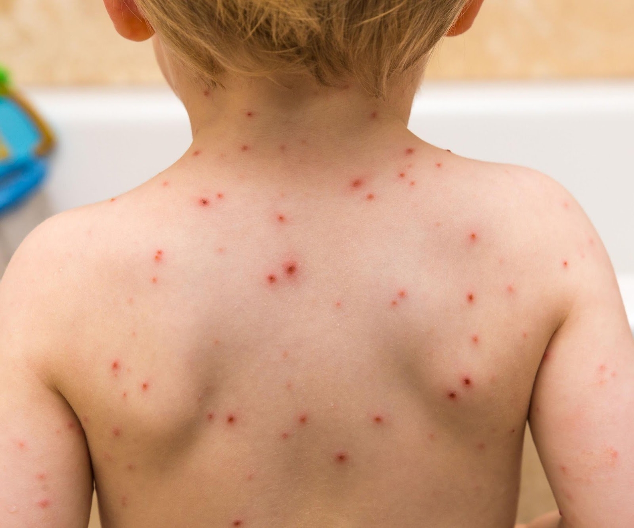 Lứa tuổi nào cần tiêm ngừa bệnh thủy đậu?
