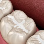 Hàn răng là gì, quy trình thực hiện như thế nào?