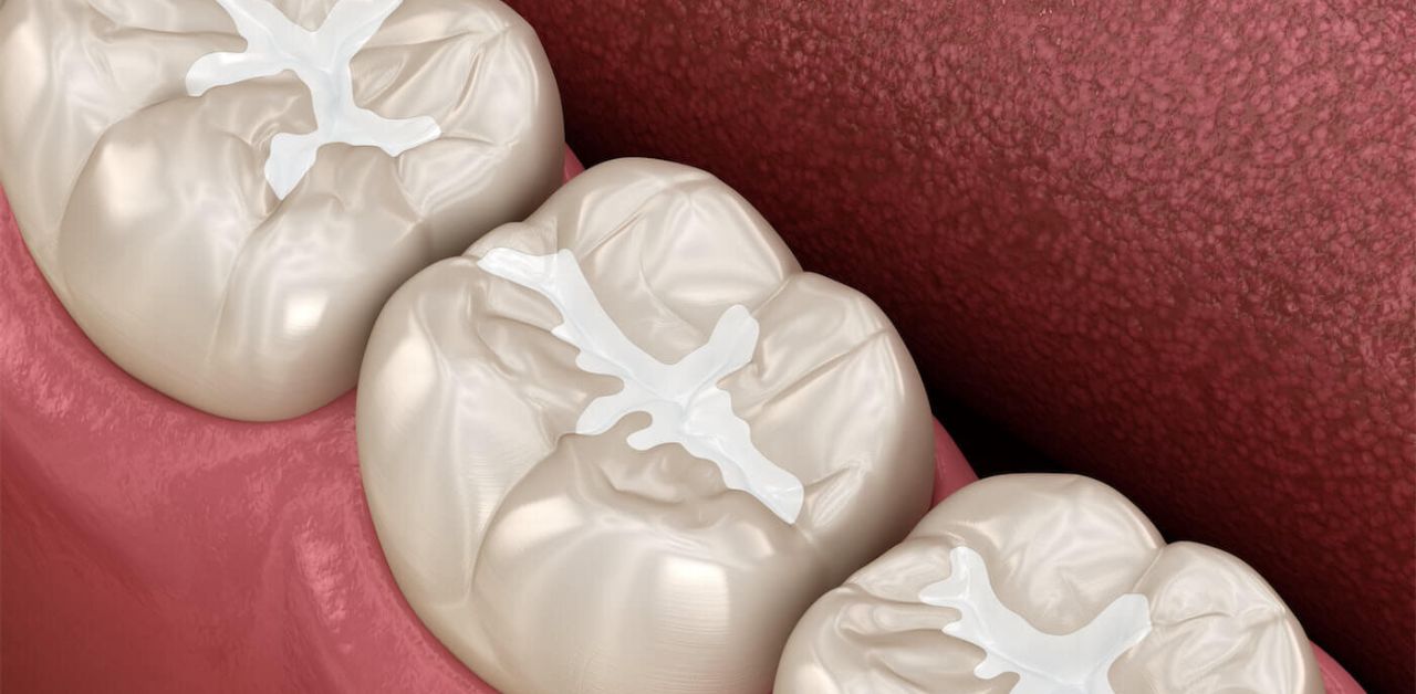 Những lợi ích của việc hàn răng là gì?
