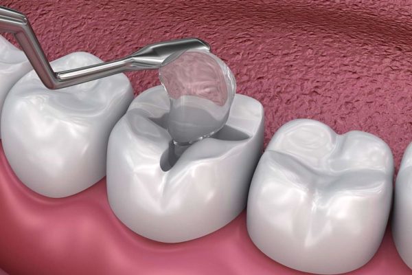 Hàn răng là gì theo các bác sĩ nha khoa, đây là kỹ thuật sử dụng các vật liệu phù hợp để lấp đầy mô răng bị thiếu do sâu, chấn thương