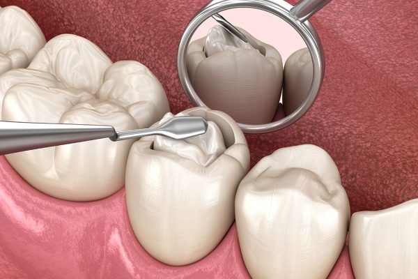 Hàn răng giúp cải thiện chức năng và thẩm mỹ do răng bị sâu, khiếm khuyết do chấn thương