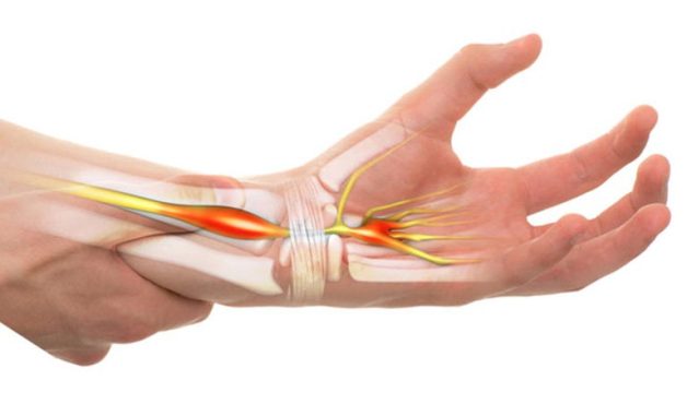 Hội chứng ống cổ tay là tình trạng dây thần kinh trong ống cổ tay bị chèn ép gây ra các cơn đau nhức ở tay