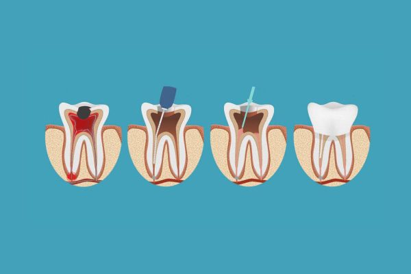 Điều trị tủy răng là kỹ thuật khắc phục tình trạng tủy bị viêm nhiễm do vi khuẩn có hại gây ra