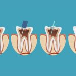Khi nào cần điều trị tủy răng triệt để?