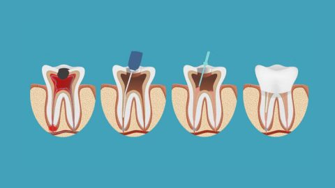 Khi nào cần điều trị tủy răng triệt để?