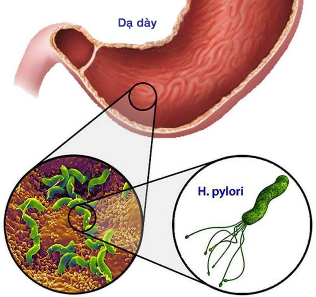 Vi khuẩn HP là nguyên nhân chính gây viêm loét bờ cong nhỏ dạ dày