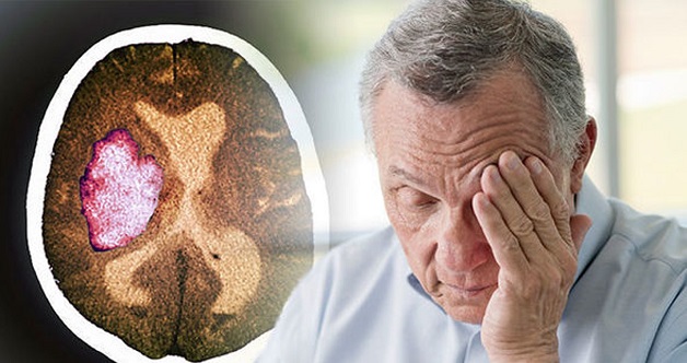 Tai biến mạch máu não ở người già dù nhẹ cũng rất nguy hiểm