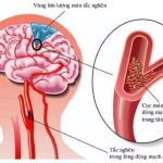 Nhồi máu não: Nguyên nhân, chẩn đoán và điều trị