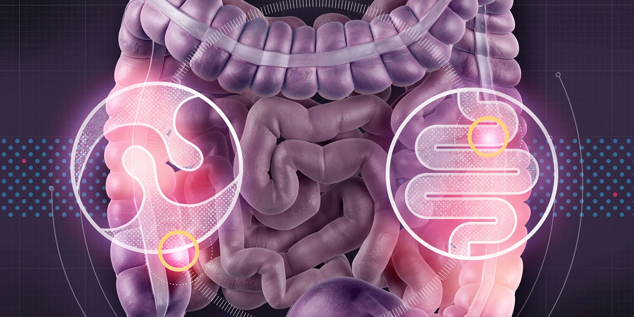 Những dấu hiệu và triệu chứng của polyp đại tràng là gì?
