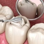 Tìm hiểu quy trình hàn răng từ A đến Z