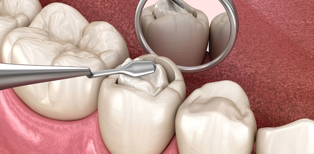  Quy trình hàn răng sâu : Tất cả những gì bạn cần biết