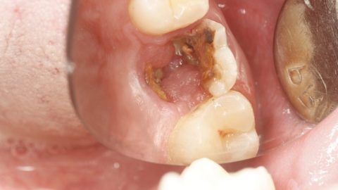 Răng sâu bị vỡ có thể dẫn đến mất răng vĩnh viễn không?