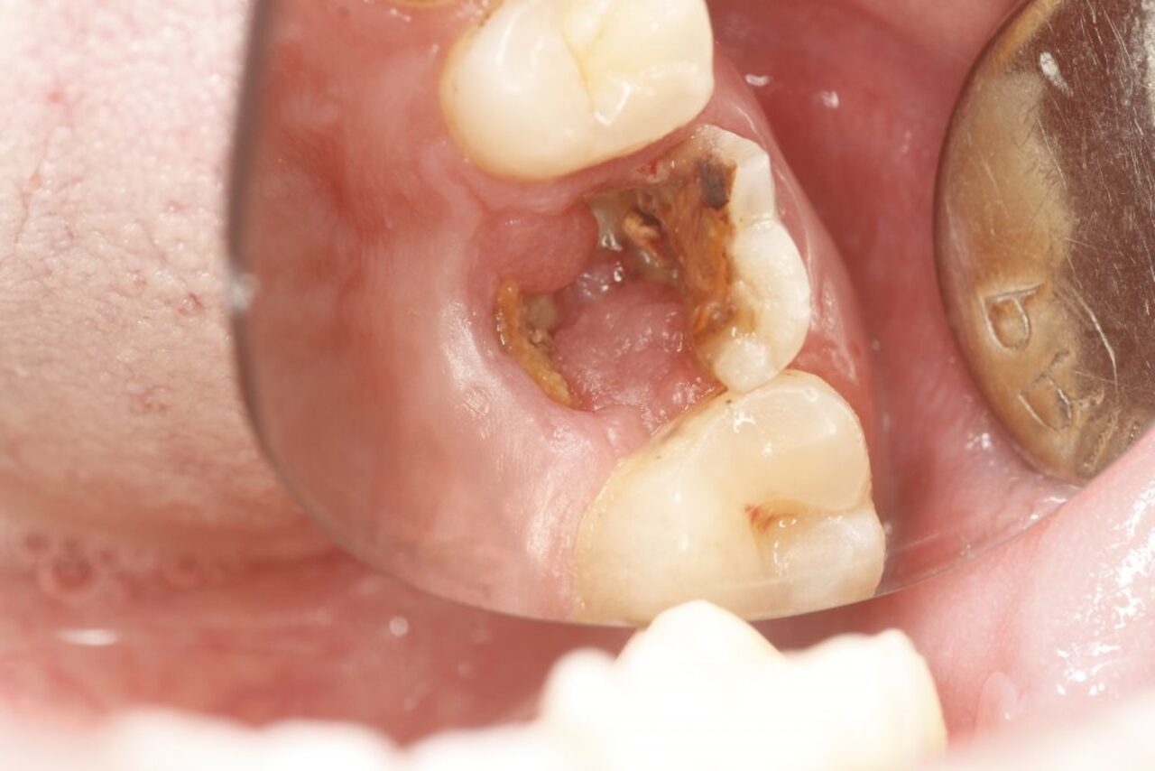 Các dấu hiệu và triệu chứng của răng sâu vỡ lớn là gì?