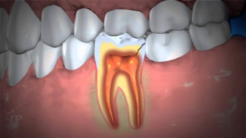 Răng viêm quanh cuống có nguy hiểm không?