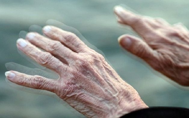 Dấu hiệu của bệnh Parkinson là run bàn tay, cánh tay, chuyển động chậm chạp,...