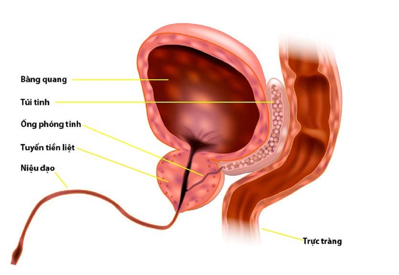 Sỏi tuyến tiền liệt có thể tái phát sau khi được điều trị không?
