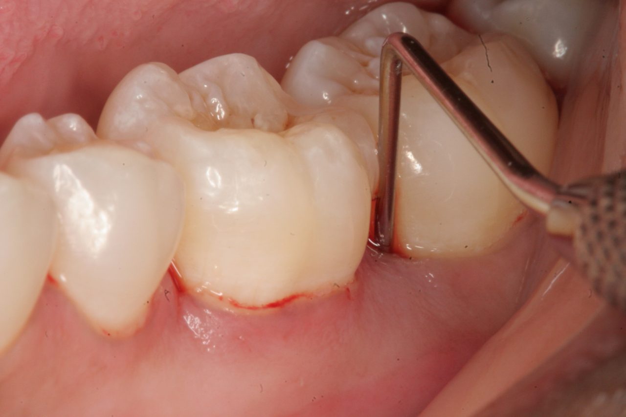 What are the common causes of swelling in the gums around the jaw and teeth?