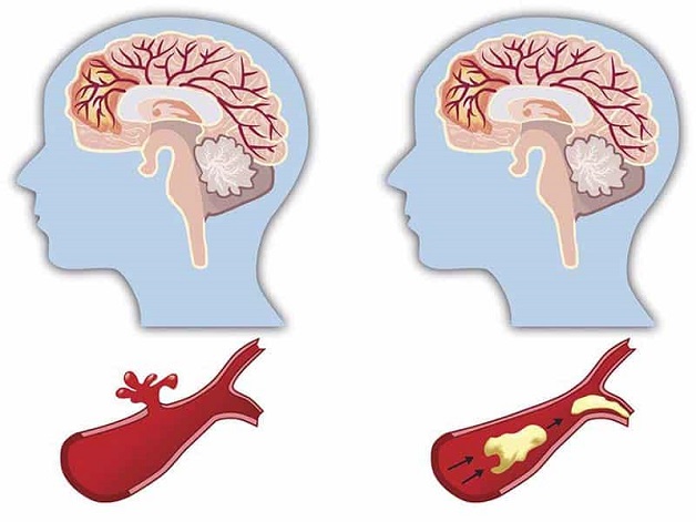 Tai biến mạch máu não có những dạng nào?