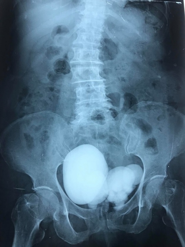 Người bệnh được chụp X-quang để xác định tình trạng của sỏi