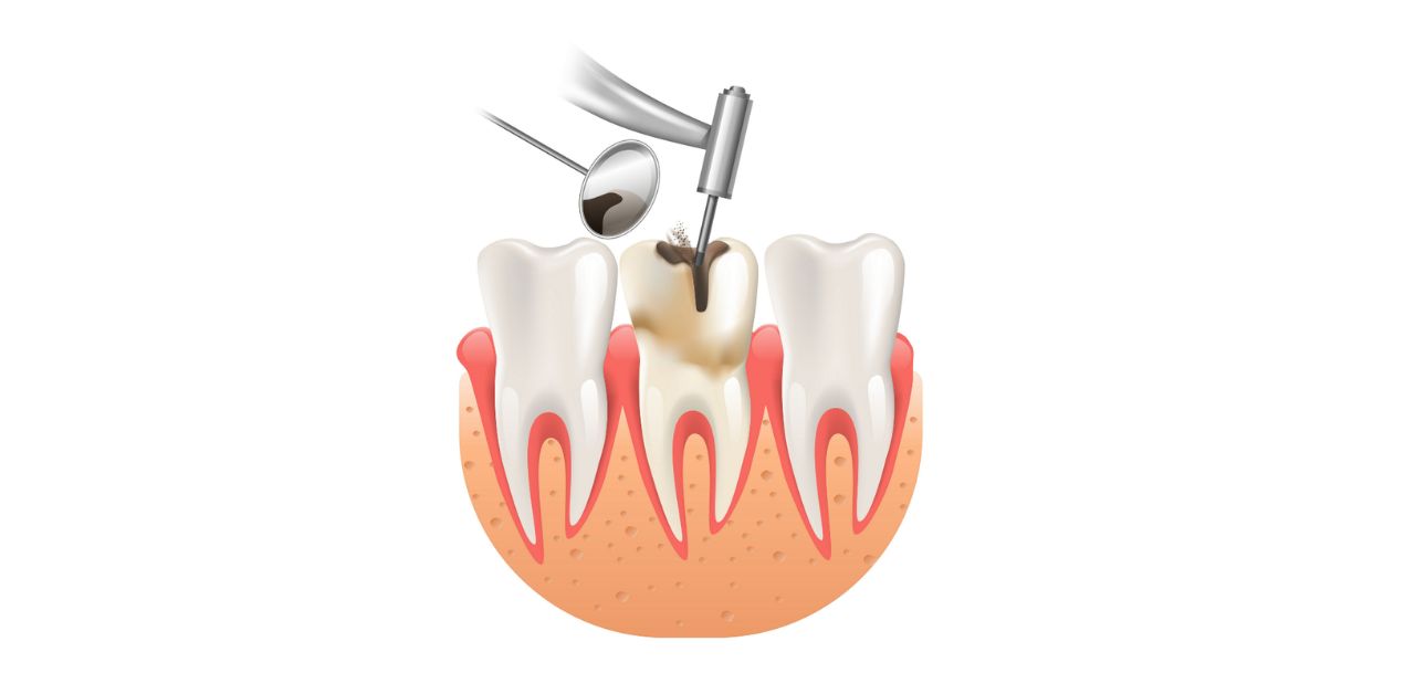 Điều trị tủy răng bao lâu?