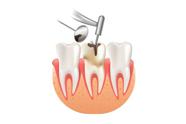 Điều trị tuỷ răng là quá trình làm sạch phần tủy răng bị viêm và trám bít ống tủy bằng các chất liệu đặc biệt