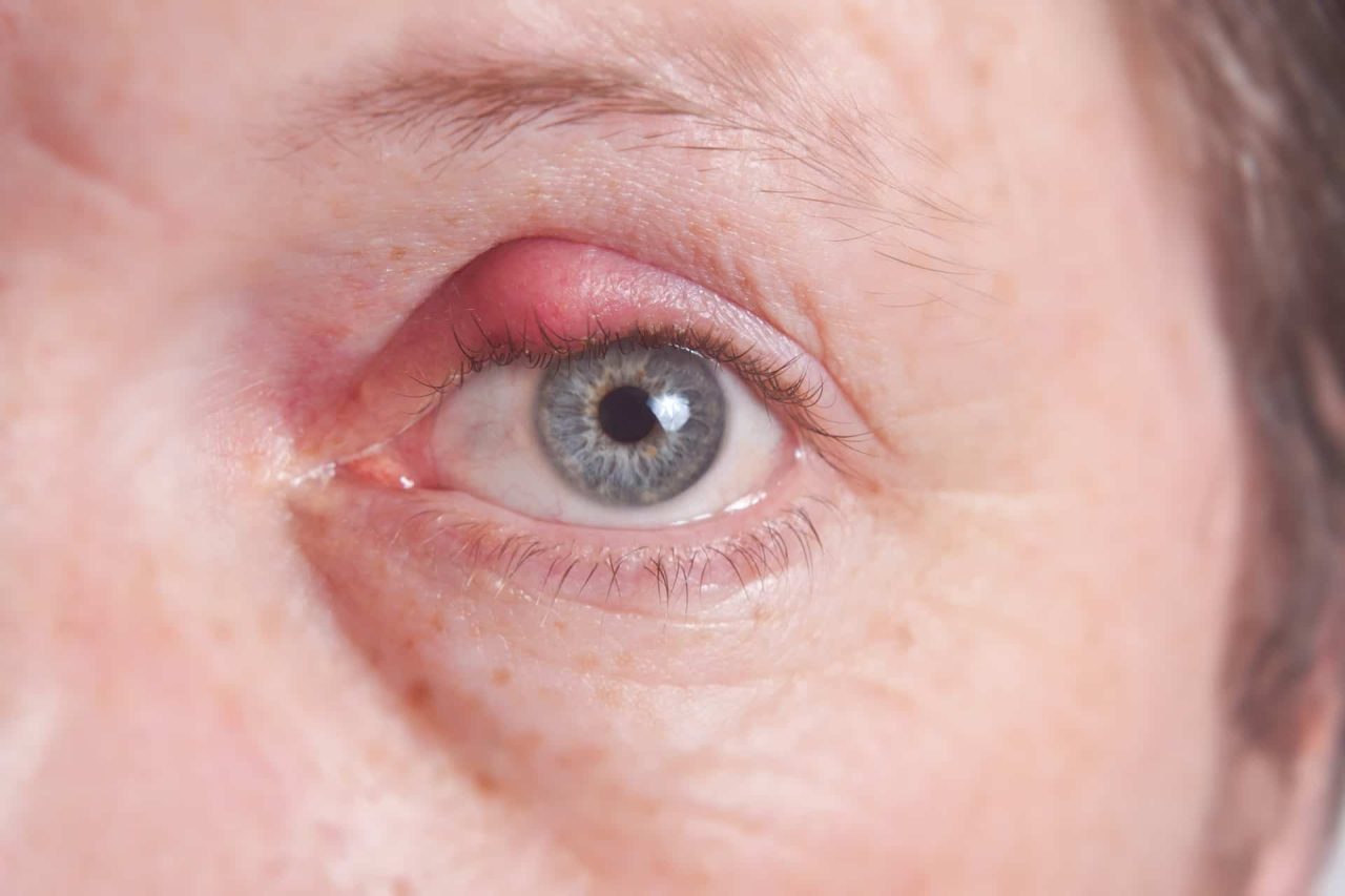 Hạn dùng của thuốc nhỏ mắt khi được sử dụng để trị lẹo mắt là bao lâu kể từ ngày sản xuất?
