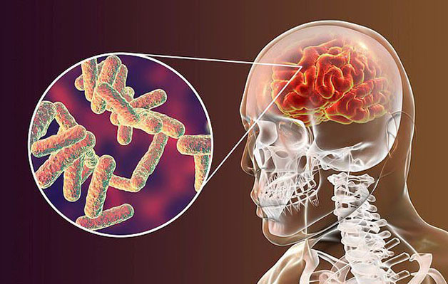 Phế cầu khuẩn có thể tấn công và gây viêm màng não, nhiễm trùng máu, viêm tai giữa, viêm phổi,...