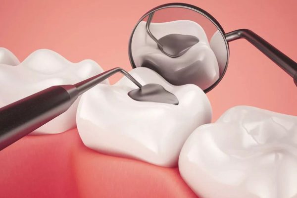Hàn trám răng sâu là thủ thuật sử dụng các vật liệu như composite, amalgam… để bù vào phần răng bị hư hỏng