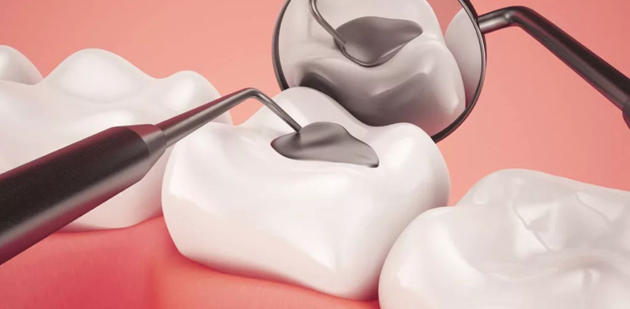  Khoan răng sâu - Tìm hiểu về vị trí đặc biệt trong hàm răng