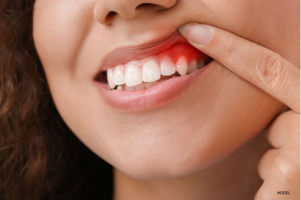 Viêm lợi là tình trạng viêm nhiễm ở các tổ chức nướu răng do vi khuẩn có hại gây ra