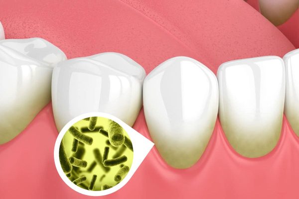 Nguyên nhân chính gây ra tình trạng viêm lợi chính là vi khuẩn từ các mảng bám, cao răng tấn công mô nướu