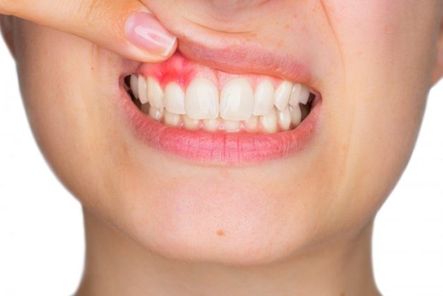 U chân răng là một biến chứng của nhiễm trùng răng