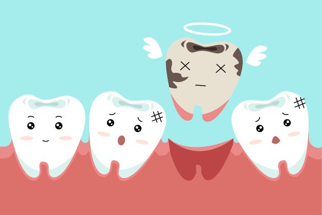 Nang chân răng làm rụng răng nguyên nhân và các răng lân cận