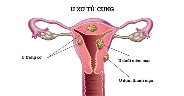 U xơ tử cung dưới thanh mạc là một trong những loại u xơ thường gặp nhất ở nữ giới