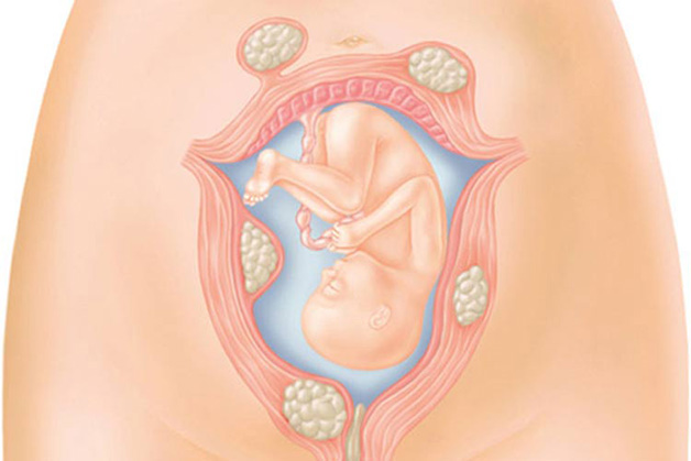 U xơ tử cung khi mang thai là tình trạng không quá hiếm gặp, gây ảnh hưởng tới mẹ bầu cũng như thai nhi