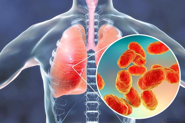 Viêm phổi do phế cầu khuẩn là hiện tượng phổ biến ở trẻ nhỏ