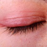 Viêm bờ mi mắt: Nguyên nhân, dấu hiệu, cách điều trị