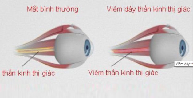 Viêm dây thần kinh thị giác là tình trạng viêm các bó sợi thần kinh trong mắt gây ra đau nhức và giảm thị lực