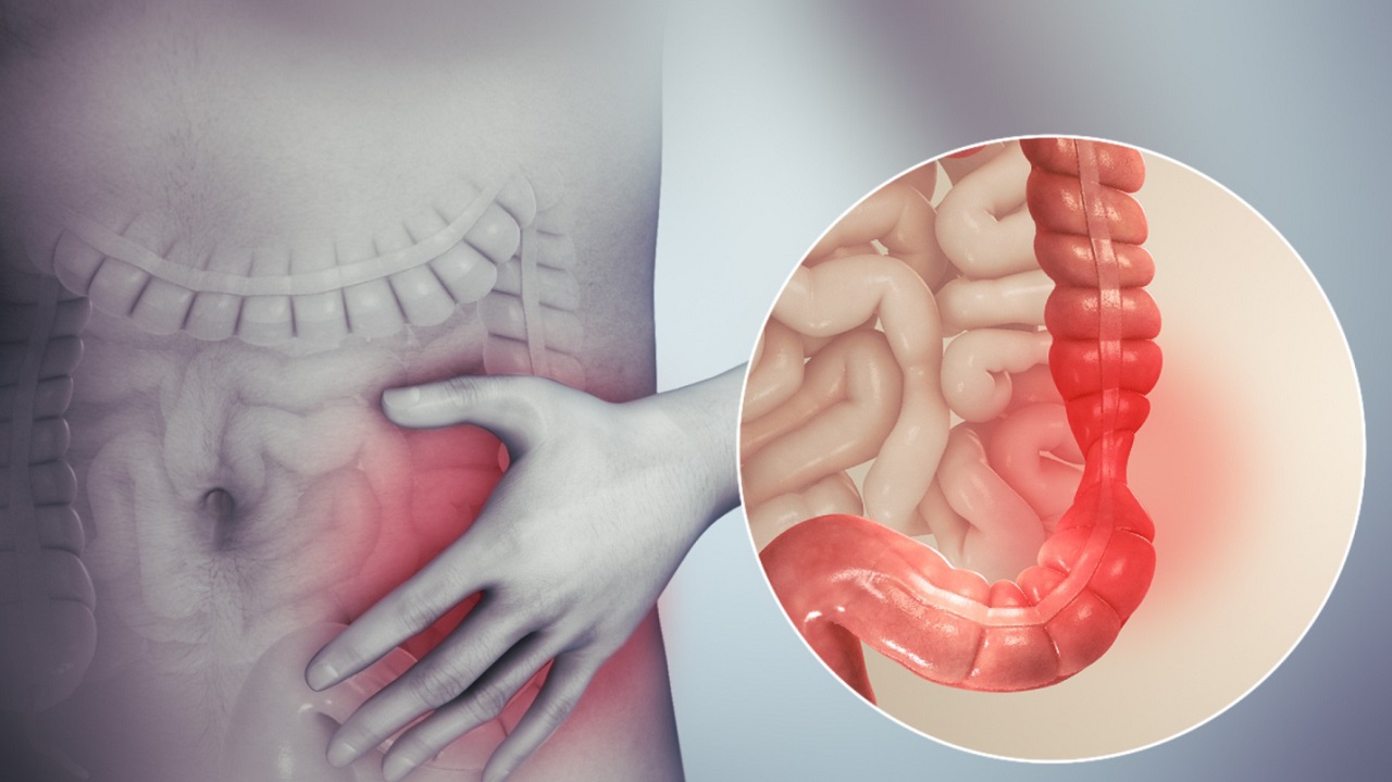 Nguyên nhân gây ra triệu chứng đau bụng khi bị đại tràng là gì?
