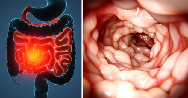 Hình ảnh nội soi mô tả bệnh Crohn ở đường ruột