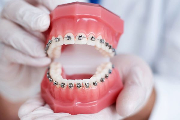Viêm lợi khi niềng răng: Nguyên nhân và cách điều trị