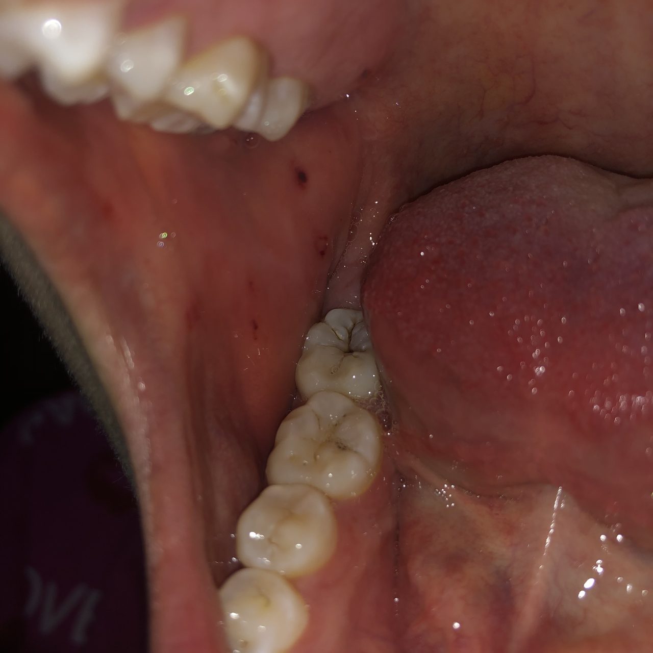Viêm má trong miệng: triệu chứng, nguyên nhân và cách điều trị?