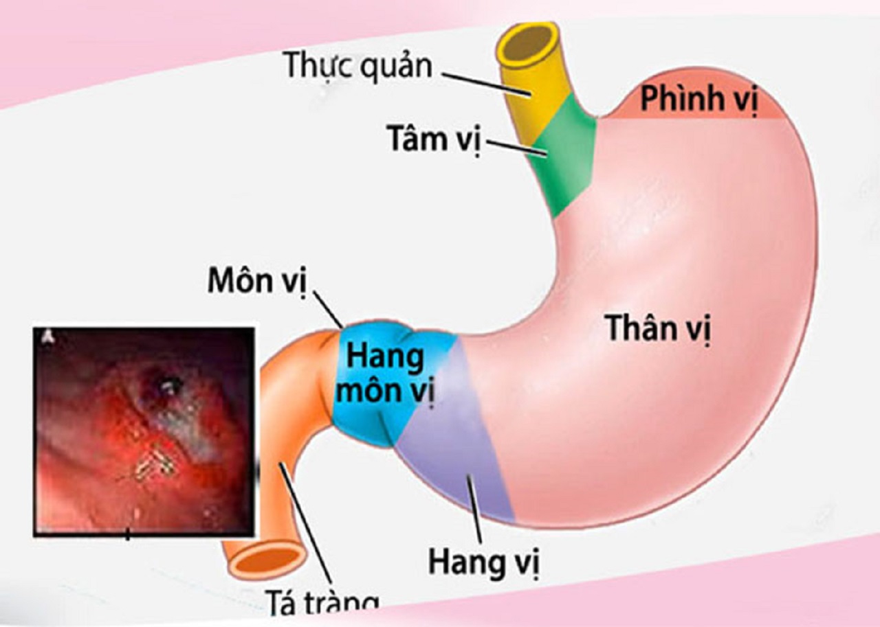 Tổng Quan Về Viêm Thân Vị Dạ Dày Tci Hospital