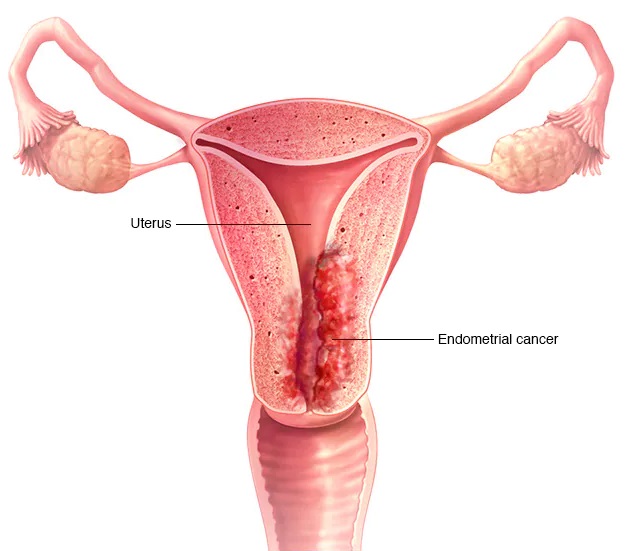 sàng lọc ung thư tử cung