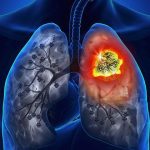 Chẩn đoán hình ảnh u phổi trong tầm soát ung thư phổi