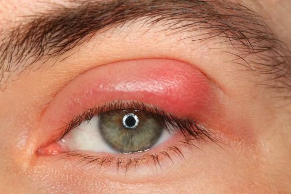 Bệnh đau mắt hột: Nguyên nhân, dấu hiệu, cách điều trị
